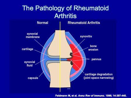 Artrite Reumatoide e Alimentazione